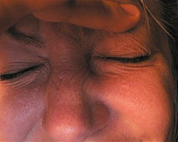 Мигрената: наследствеността най-често е определяща