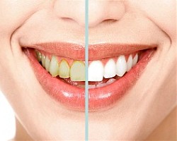 Най-вредните продукти за зъбите