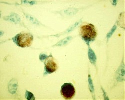 Хламидиите - най-разпространеното заболяване, предавано по полов път