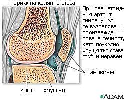 ревматоиден артрит